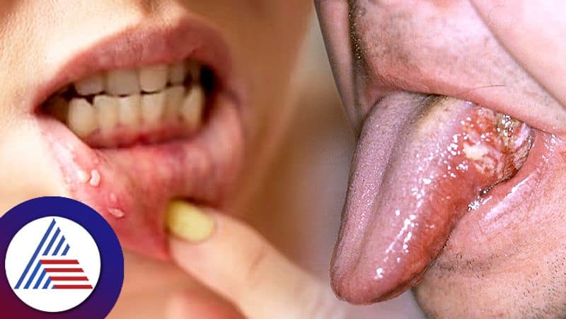 Health Ministry Has Listed Symptoms Of Oral Cancer roo