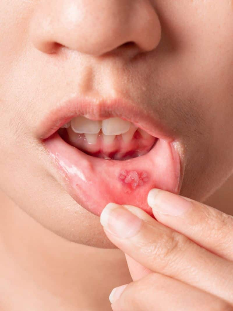 6 foods that can trigger mouth ulcers 