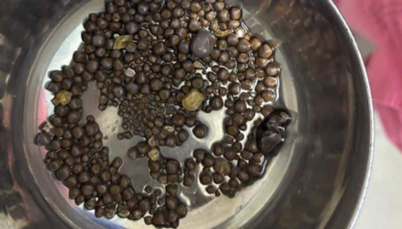 418 kidney stones removed from 60 year old patient