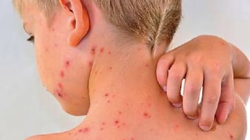 Scary number of chickenpox patients revealed in Kerala, 9 people died know about chickenpox symtoms xbw