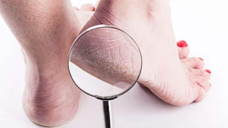 home remedies for cracked heels zkamn