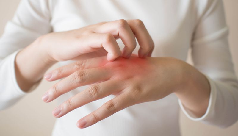 symptoms and tips to prevent eczema