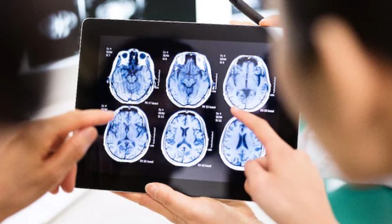 More than 3 billion people suffering from neurological conditions WHO study