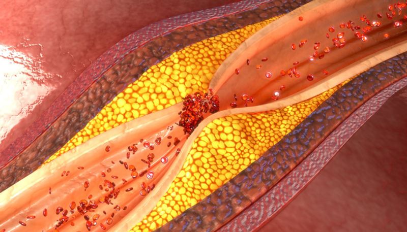 four home remedies to lower high cholesterol