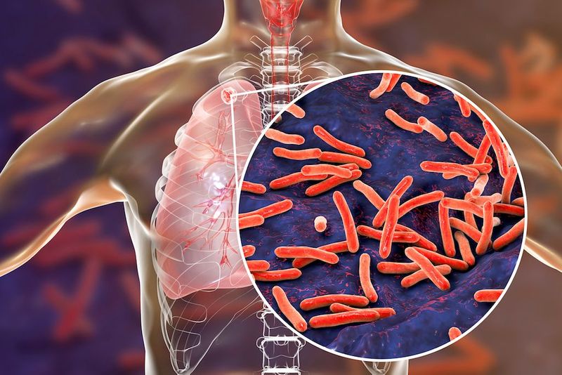 tuberculosis overtakes covid 19 as leading infectious disease killer who 