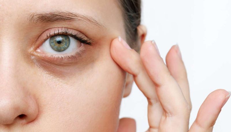 home remedy for remove dark circles under eyes 