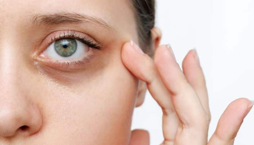 dark circles