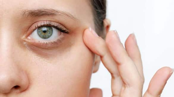 easy and simple tips for remove dark circles 