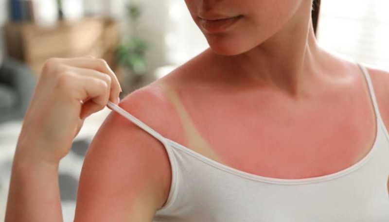 natural remedies to help remove sun tan