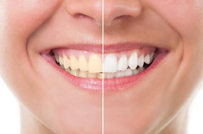white teeth