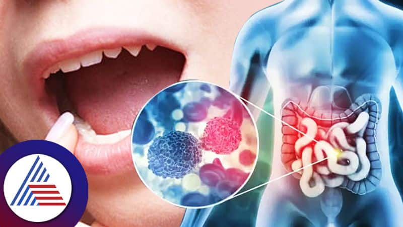 Study says oral bacteria can cause colon cancer pav 