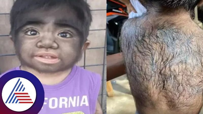 Hairiest Boy Diagnosed With Rare Werewolf Syndrome Here is All You Need To Know About It skr