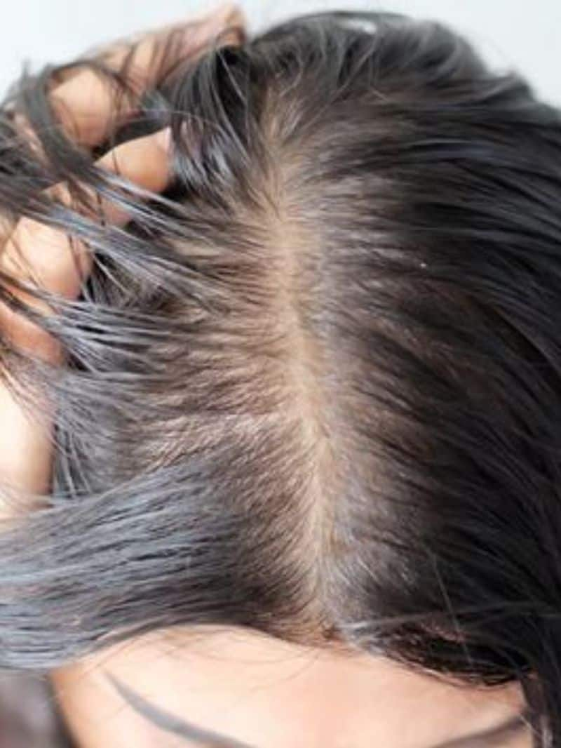 5 Effective tips to avoid greasy hair this summerrtm 