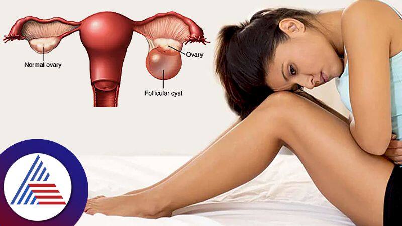 Know more about ovarian cyst which usually women suffer due to modern lifestyle pav 