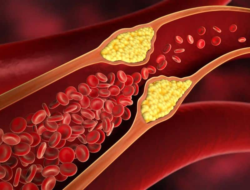 High cholesterol Know how lifestyle modifications help to reduce high triglyceride levels RBA