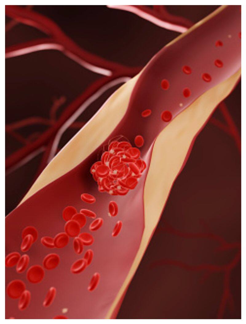 eight symptoms of high cholesterol in men