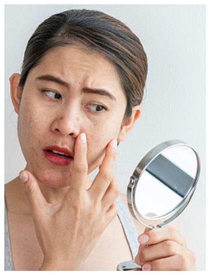 How to remove dark circles at home?