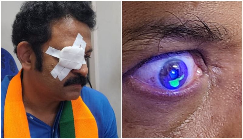 Kollam NDA candidate Krishna Kumar eye injured while campaigning