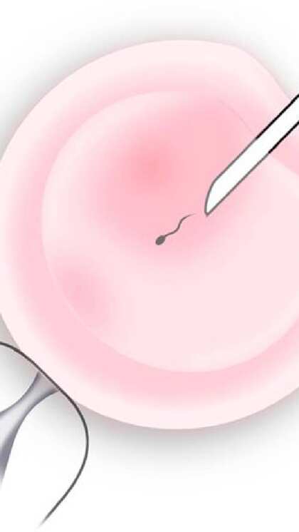 IUI ट्रीटमेंट में पतली ट्यूब से गर्भाशय में पहुंचाया जाता है स्पर्म