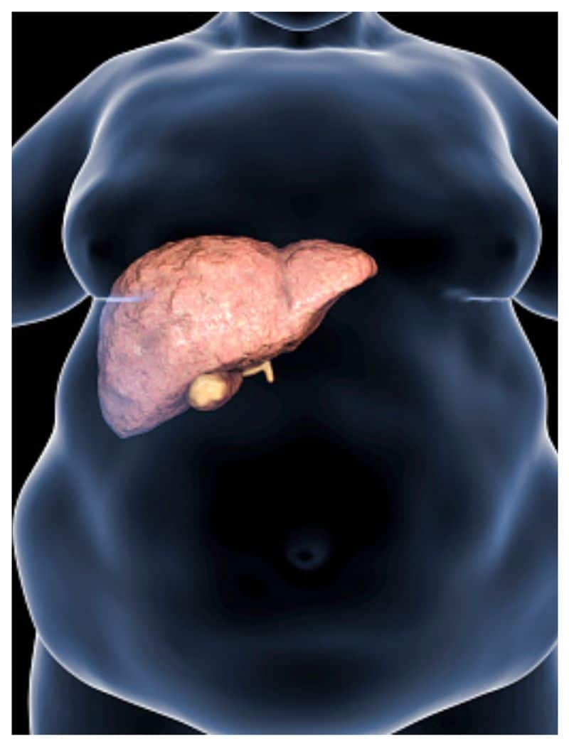 nonalcoholic fatty liver disease symptoms and causes