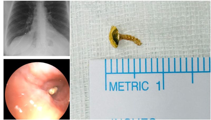 nose pin went missing 12 years ago 44 year women suffers breathing issues shocking finding in Rigid bronchoscopy