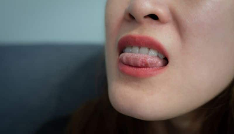 easy home remedies to get relief from mouth ulcer