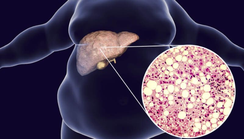 Swelling in these body parts can indicate Fatty liver disease