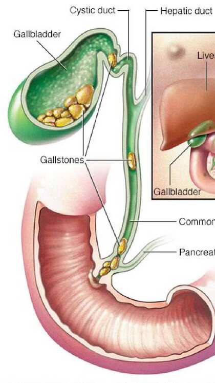 Gall bladder stone क्या होता है?