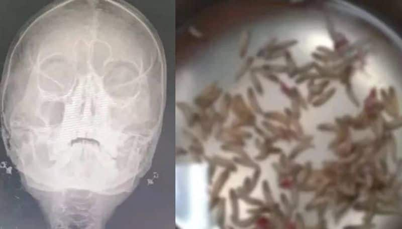 woman with stuffy nose and facial pain discovered hundreds of maggots inside in Thailand 