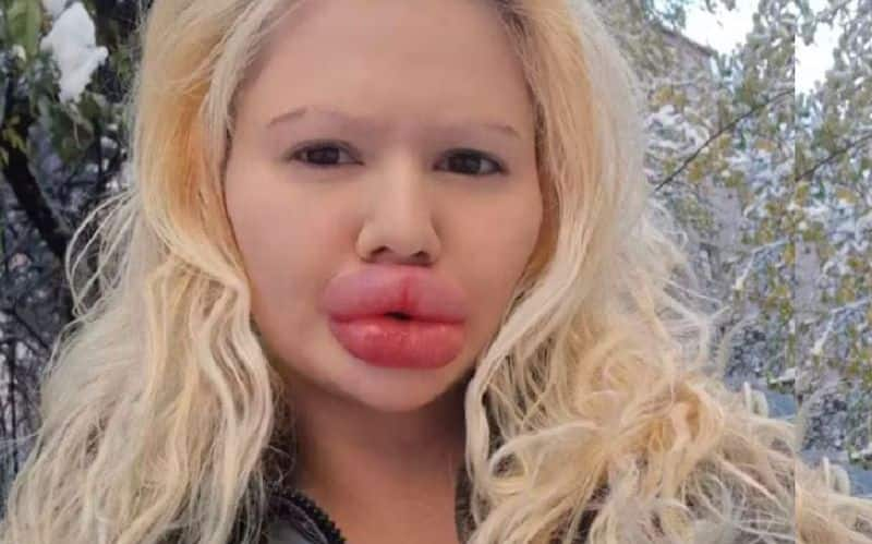 Woman Undergoes 4 Surgeries For Bigger Lips, Now Finding It Hard To Find A Partner Vin