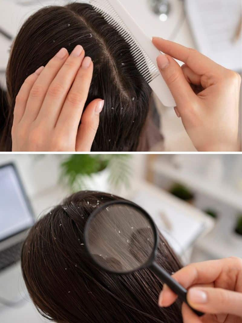 Home remedies: 7 DIY solutions to get rid of dandruff naturally gcw eai