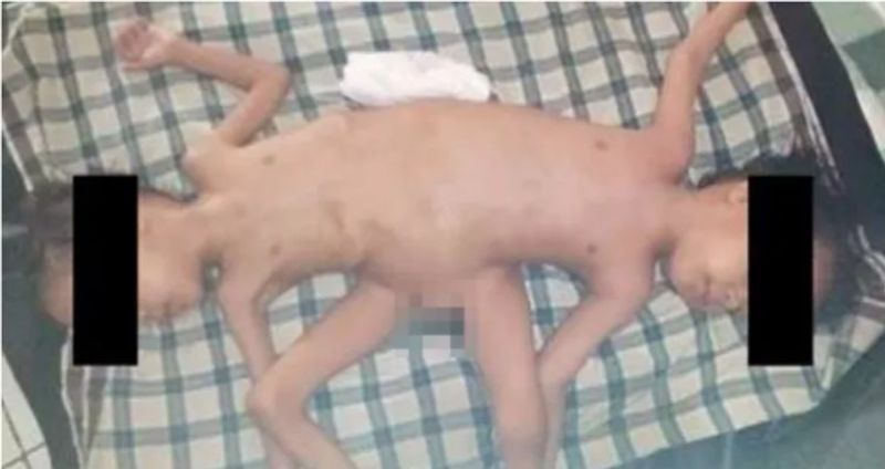 1 in 2 million case: Rare Indonesian conjoined twins, born with 4 arms & 3 legs, undergo surgical correction see photos snt