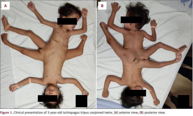 1 in 2 million case: Rare Indonesian conjoined twins, born with 4 arms & 3 legs, undergo surgical correction see photos snt