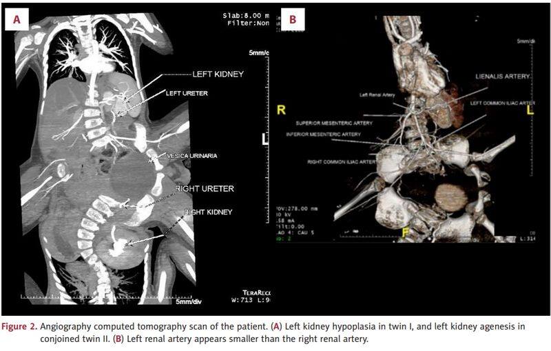 1 in 2 million case: Rare Indonesian conjoined twins, born with 4 arms & 3 legs, undergo surgical correction see photos snt