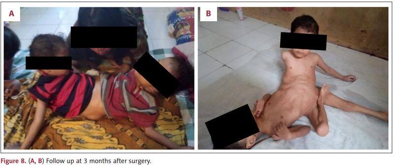 1 in 2 million case: Rare Indonesian conjoined twins, born with 4 arms & 3 legs, undergo surgical correction see photos snt