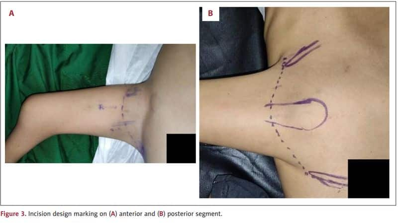 1 in 2 million case: Rare Indonesian conjoined twins, born with 4 arms & 3 legs, undergo surgical correction see photos snt