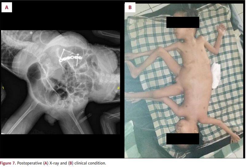 1 in 2 million case: Rare Indonesian conjoined twins, born with 4 arms & 3 legs, undergo surgical correction see photos snt