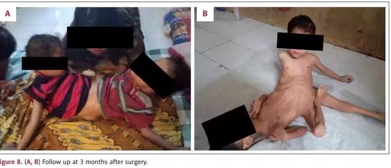 1 in 2 million case Rare Indonesian conjoined twins born with 4 arms & 3 legs undergo surgical correction skr