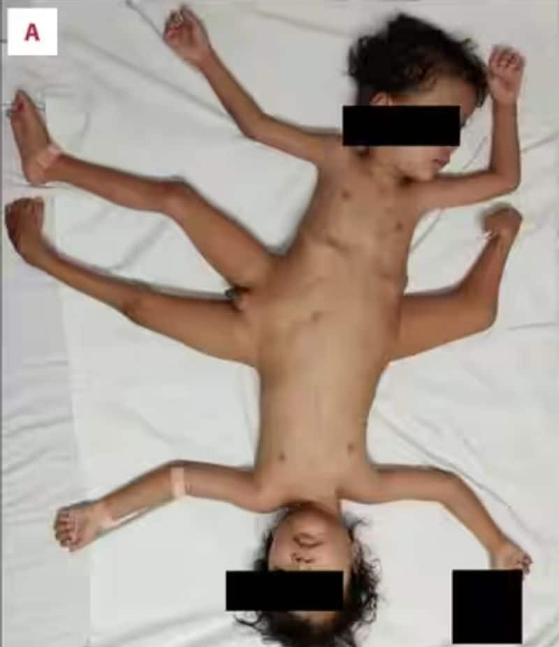 1 in 2 million case Rare Indonesian conjoined twins born with 4 arms & 3 legs undergo surgical correction skr