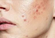 is-popping-pimples-safe-harms