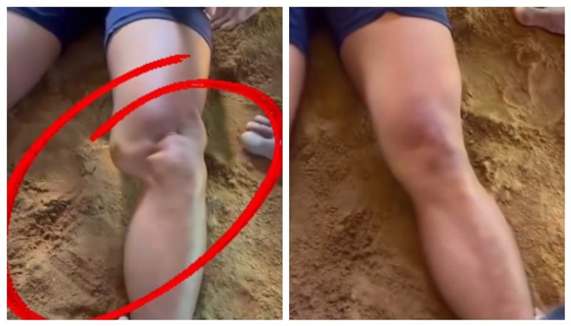 video of a man fixes dislocated knee with in seconds went viral in social media