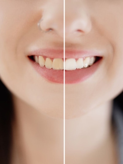 8 Ways to whiten your teeth naturally