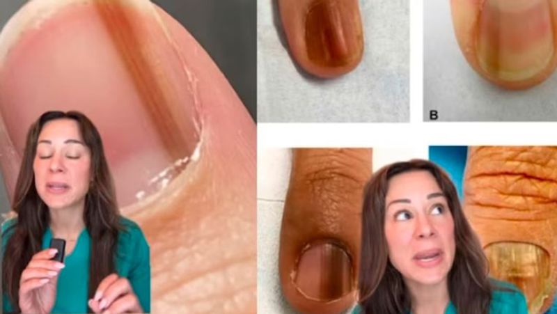 Dermatologist Reveals Dark Vertical Line On Your Nails Could Be Cancer Vin