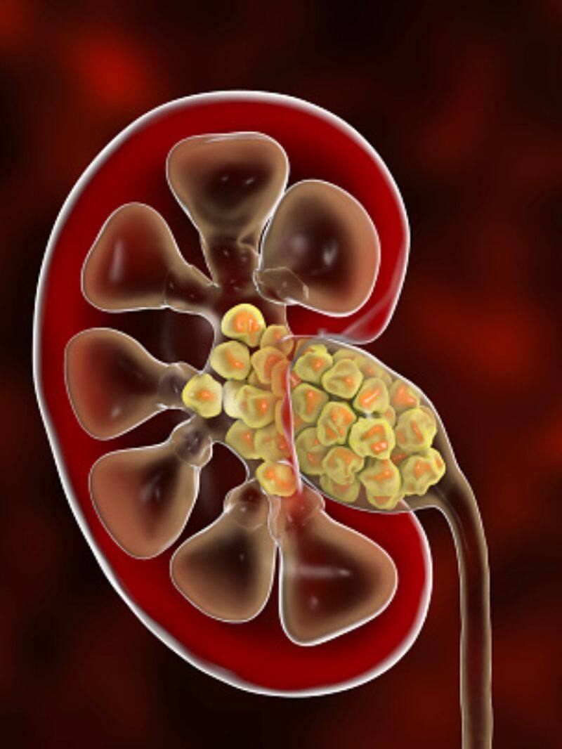 what are the symptoms of kidney stones