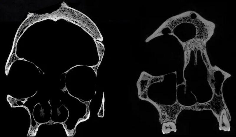 Cut marks on 4,000-year-old skulls suggest ancient Egyptians attempted cancer treatment; see pictures snt