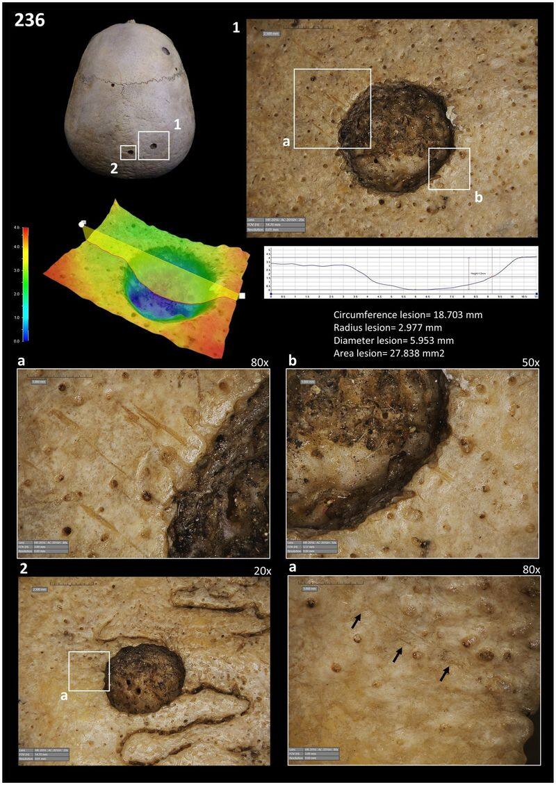 Cut marks on 4,000-year-old skulls suggest ancient Egyptians attempted cancer treatment; see pictures snt