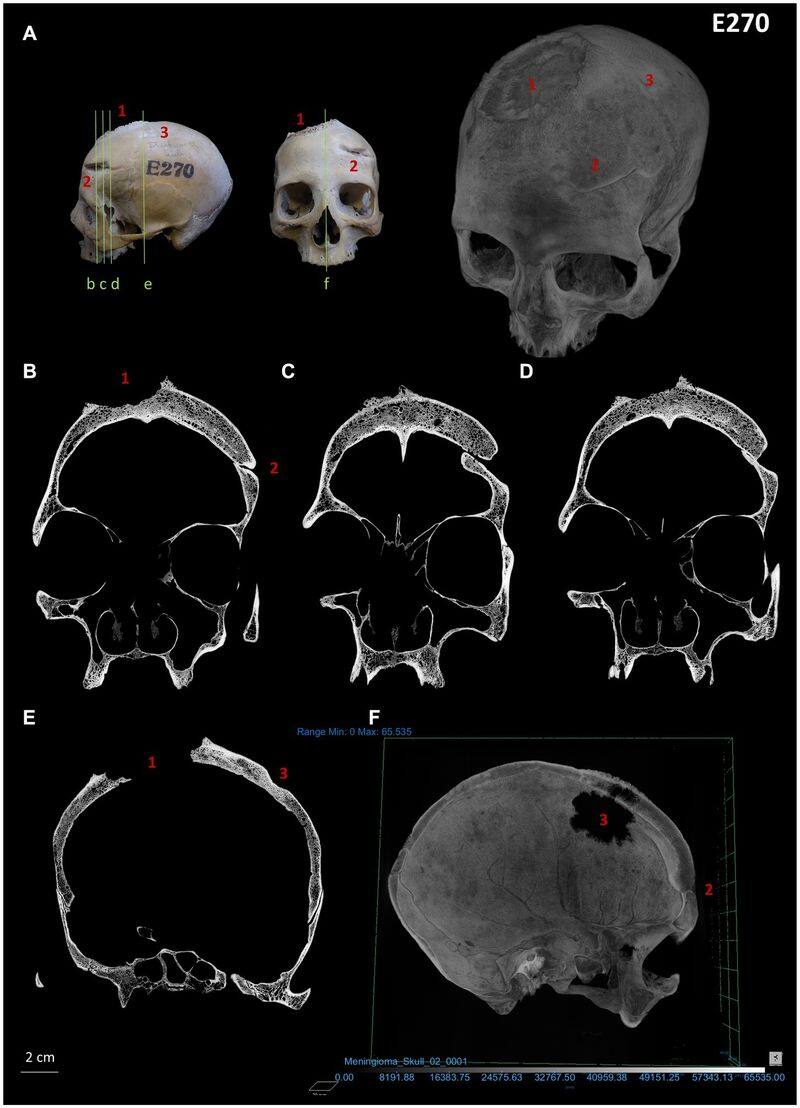 Cut marks on 4,000-year-old skulls suggest ancient Egyptians attempted cancer treatment; see pictures snt