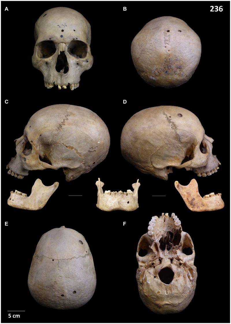 Cut marks on 4,000-year-old skulls suggest ancient Egyptians attempted cancer treatment; see pictures snt