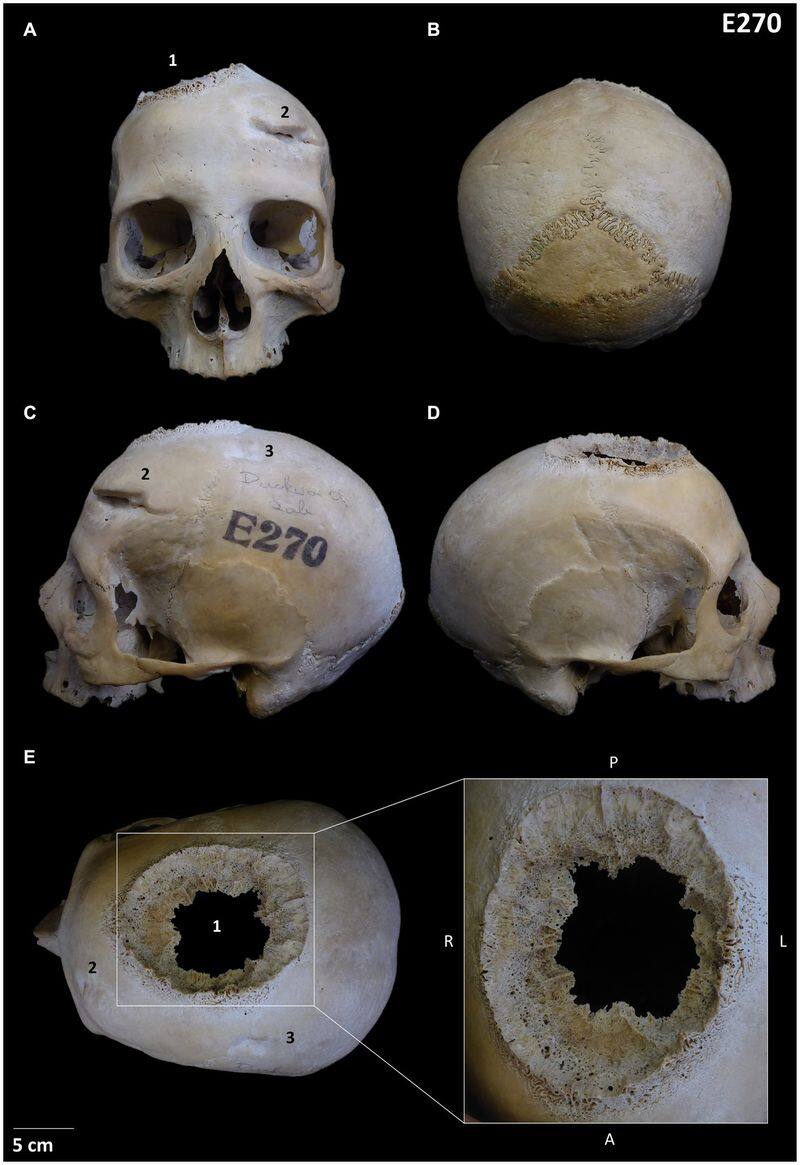 Cut marks on 4,000-year-old skulls suggest ancient Egyptians attempted cancer treatment; see pictures snt