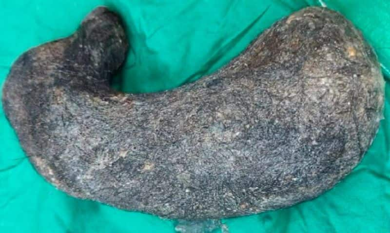 Doctors In Chitrakoot Take Out 2.5 Kg Hair From Womans Stomach Vin